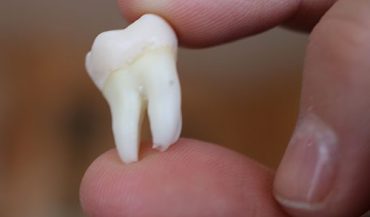 Wisdom Tooth Extraction Dentist Dee Why